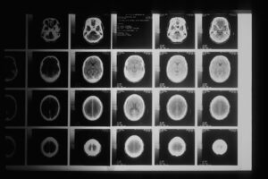 Can Radon Cause Brain Tumors?